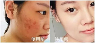 皮膚科醫(yī)生力薦 醫(yī)用面膜如何一招擺脫敏感肌困擾？